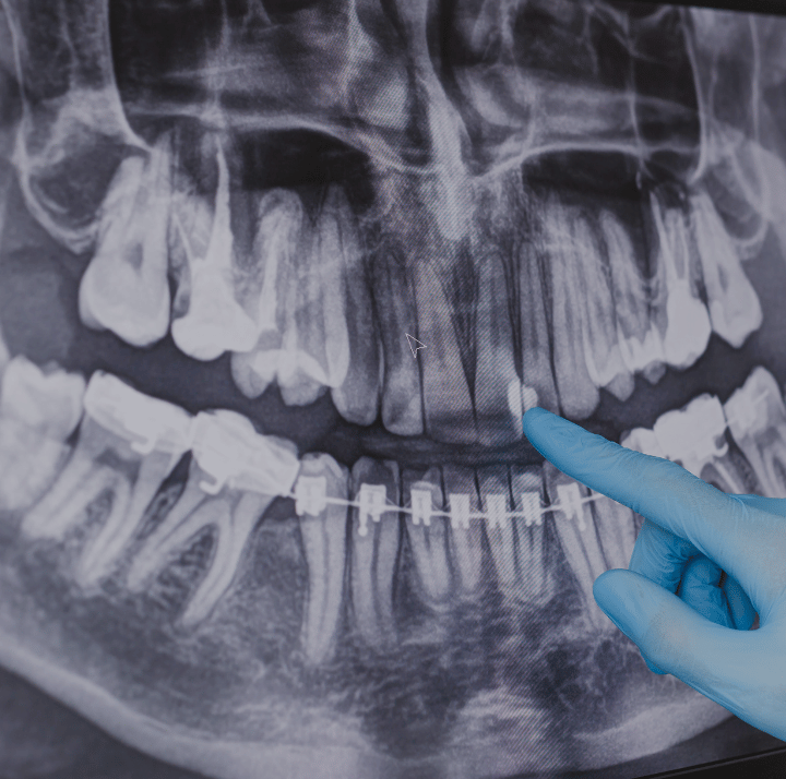 Root Canal