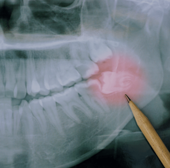 Tooth Extraction