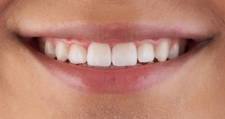 After - Deansgate Dental Studio