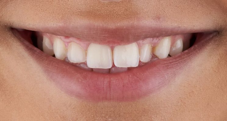 Before - Deansgate Dental Studio